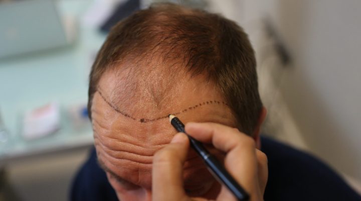Close-up of a person drawing a curved line along their receding hairline with a marker, likely planning a hair restoration procedure.