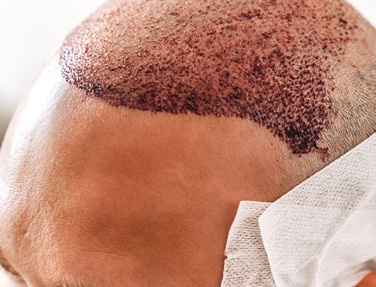 Close-up of a scalp after hair transplant surgery, showing grafted areas and a white bandage wrapped around the side.