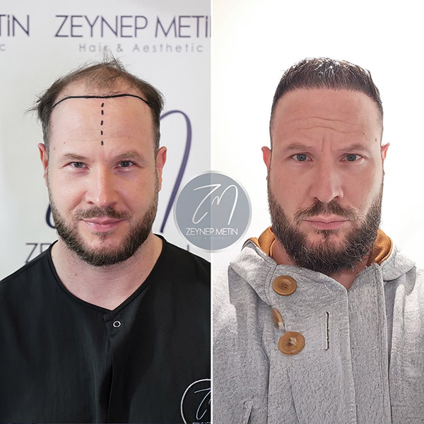sapphire-hair-transplant-bef-3