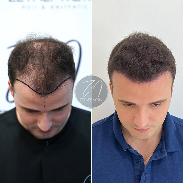 sapphire-hair-transplant-bef-5