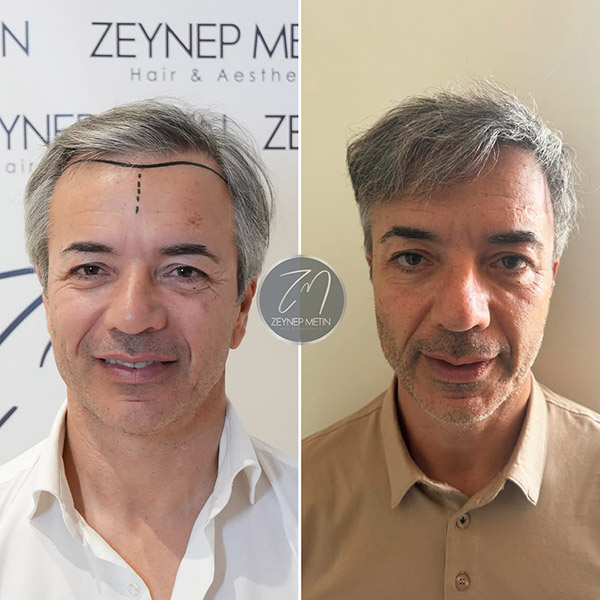 sapphire-hair-transplant-bef-7