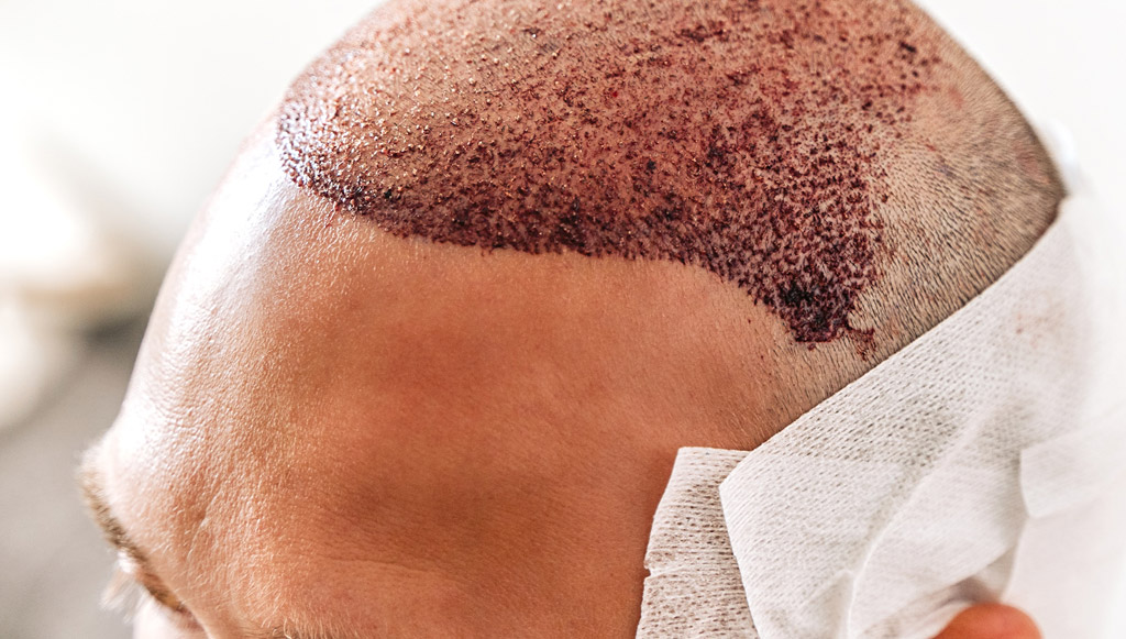 Close-up of a scalp with freshly transplanted hair grafts along the front, with a white bandage on the side.