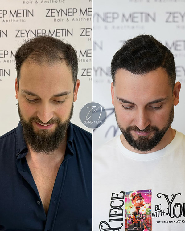 dhi-hair-transplant-before-after-1