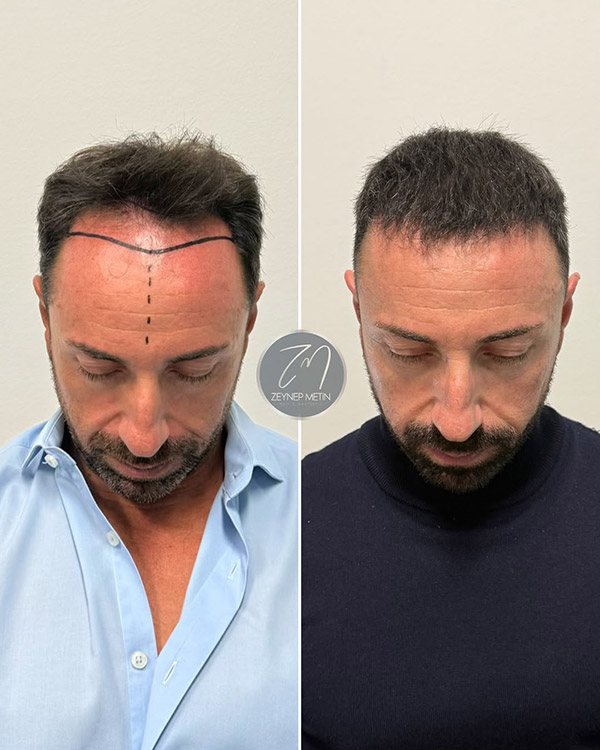 dhi-hair-transplant-before-after-4