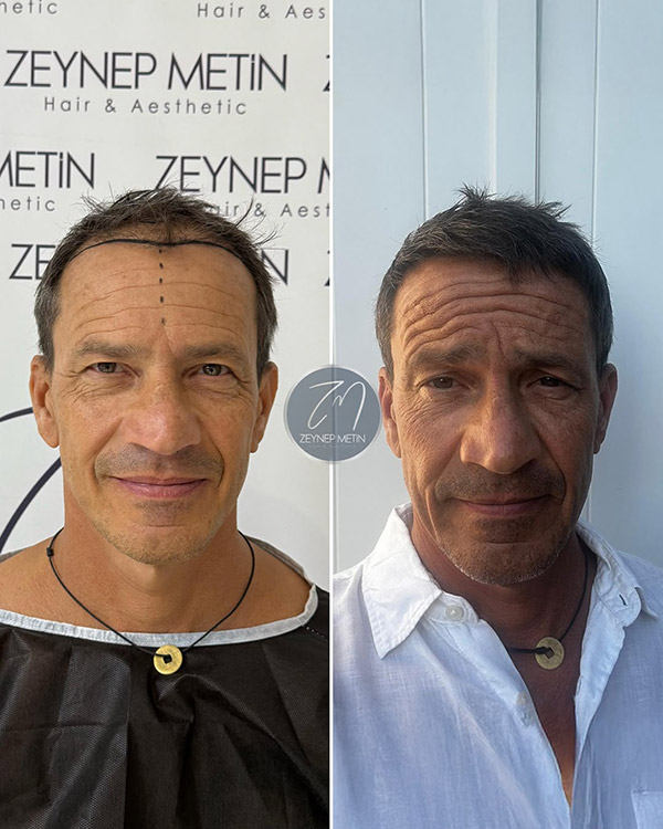 dhi-hair-transplant-before-after-5