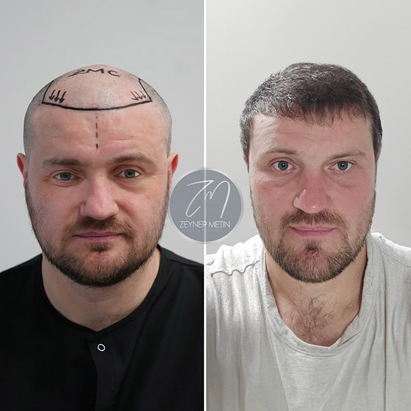 sapphire-hair-transplant-bef-2