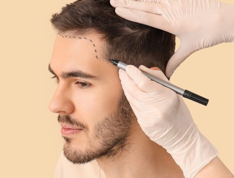 Medical professional in gloves marks a man’s hairline with a marker to plan a cosmetic procedure like a hair transplant.