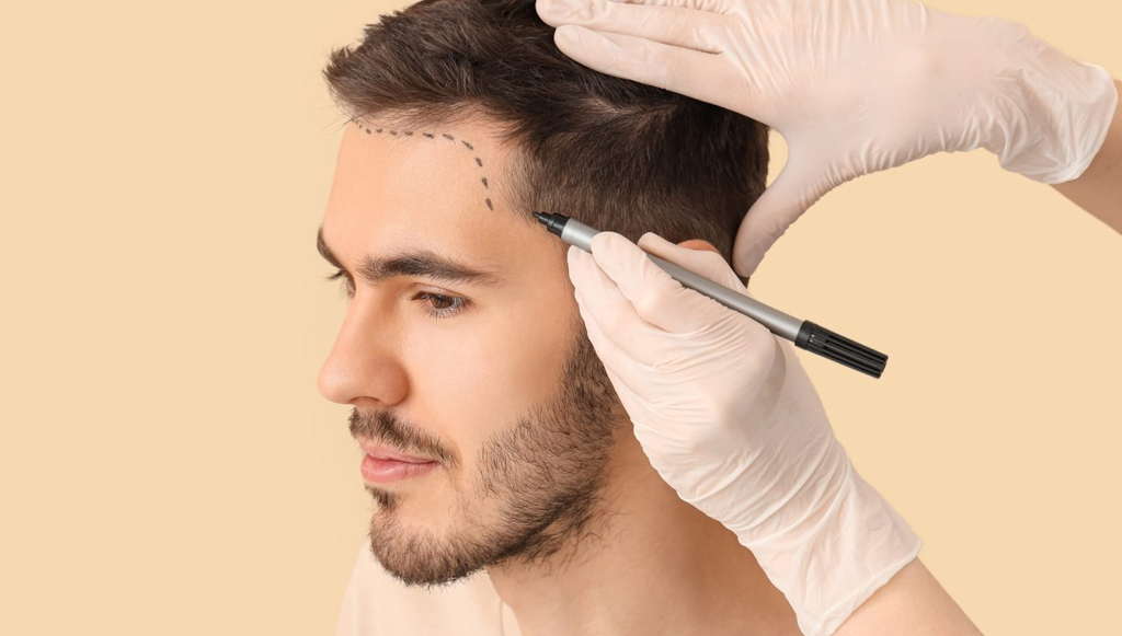 Medical professional in gloves marks a man’s hairline with a marker to plan a cosmetic procedure like a hair transplant.