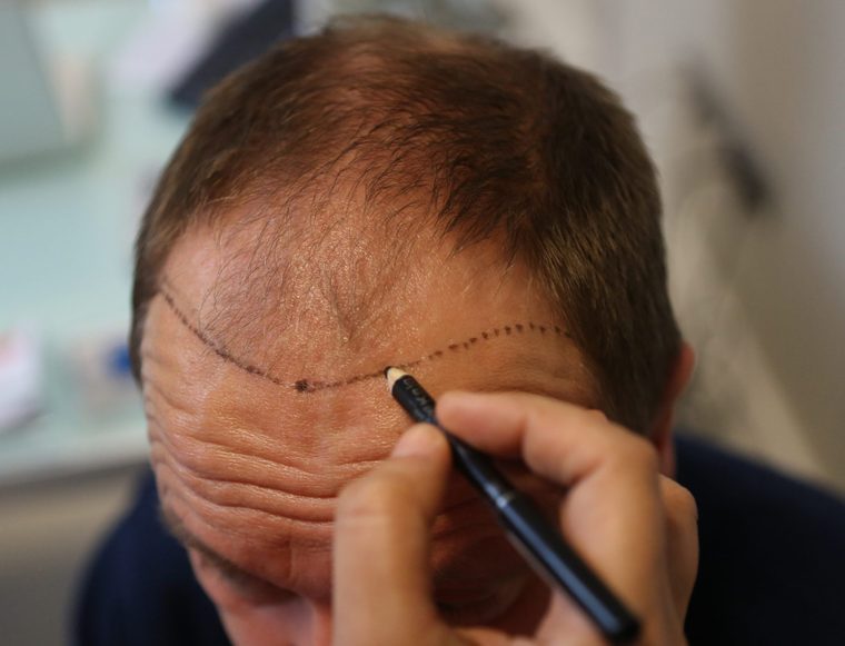 Close-up of a hand drawing a dotted line along a man's hairline with a marker on his forehead.