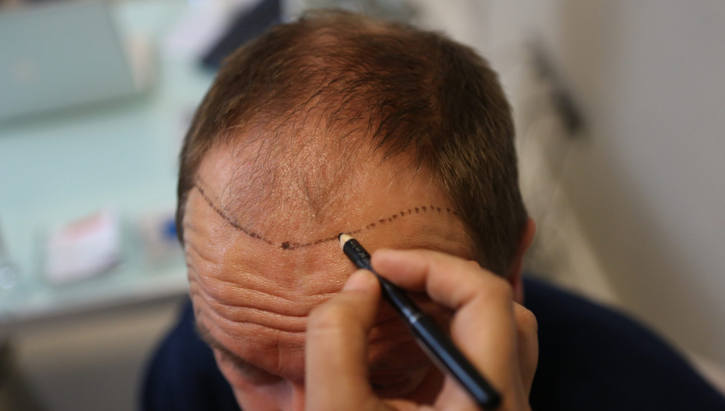 Close-up of a hand drawing a dotted line along a man's hairline with a marker on his forehead.