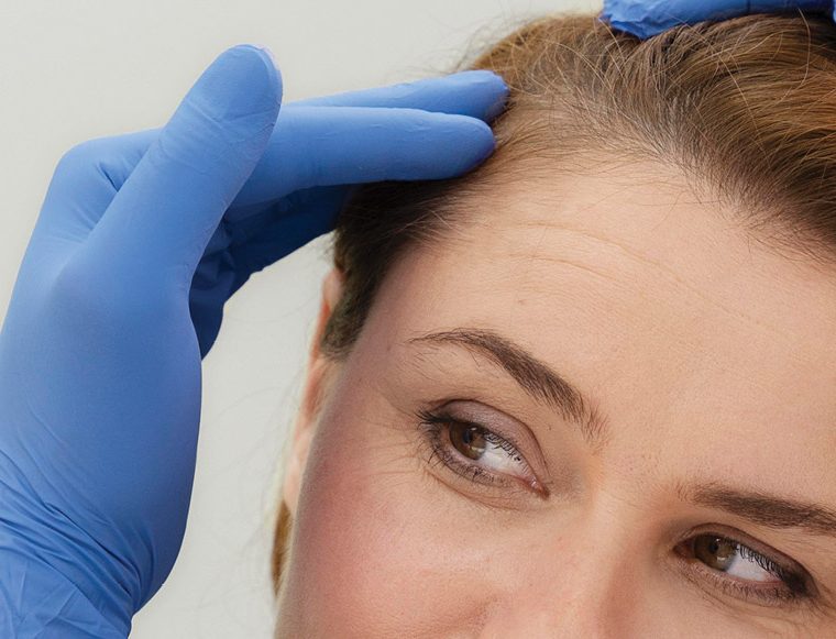 Close-up of a person with blue-gloved hands styling or examining hair at the scalp near the forehead, in a clinical setting.