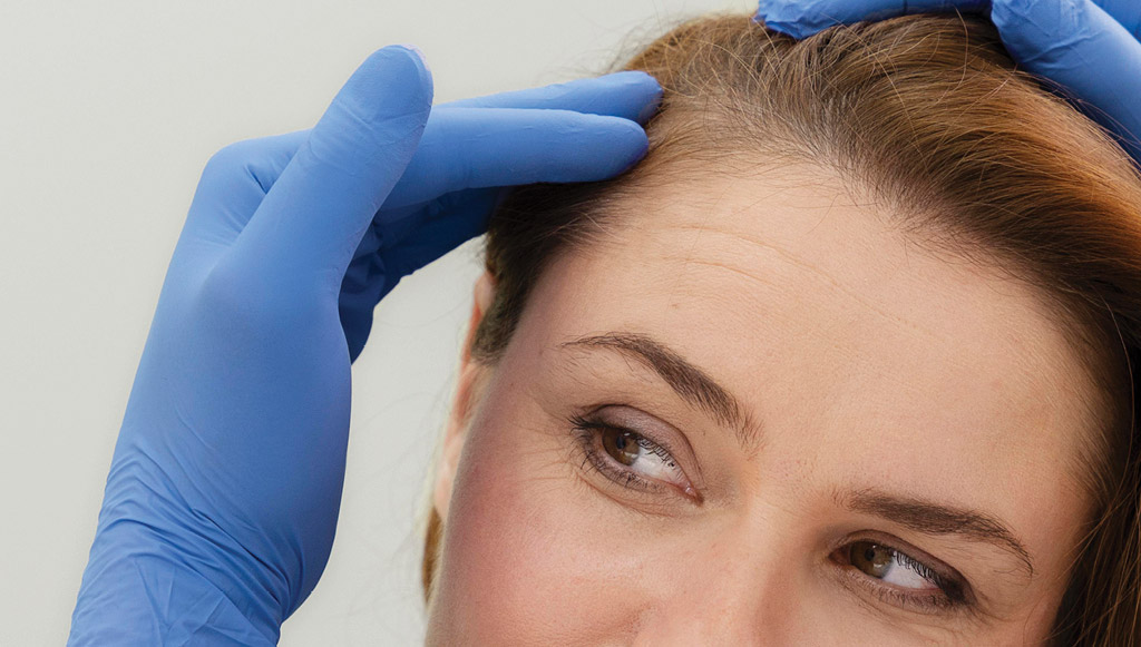 Close-up of a person with blue-gloved hands styling or examining hair at the scalp near the forehead, in a clinical setting.