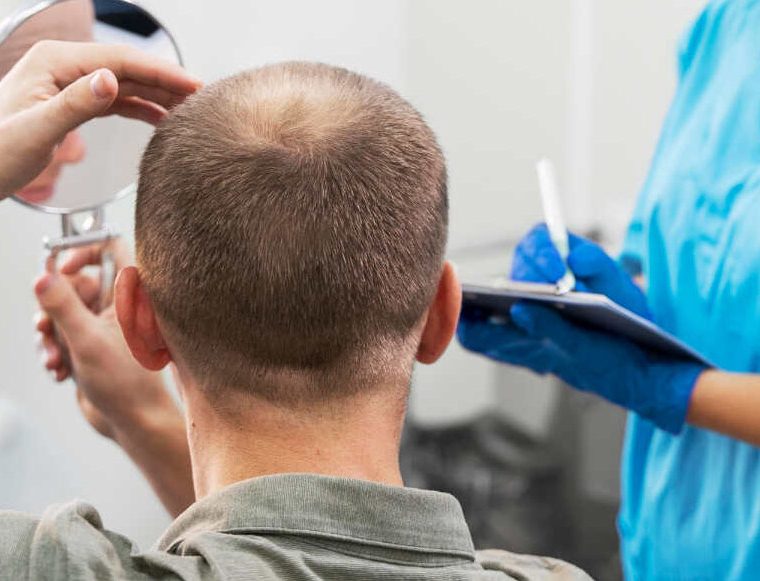 Patient facing away as a clinician in blue scrubs examines the scalp with a mirror and takes notes on a clipboard nearby.