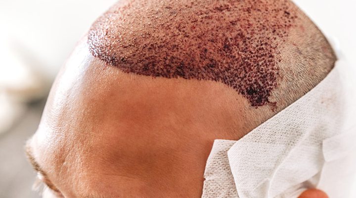 Close-up of a patient’s scalp after a hair transplant, showing a bandaged area and dark blood scabs along the hairline.