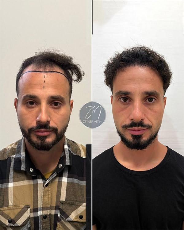 fue-method-before-after-1