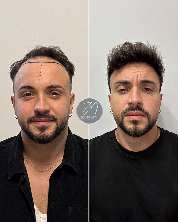 fue-method-before-after-2