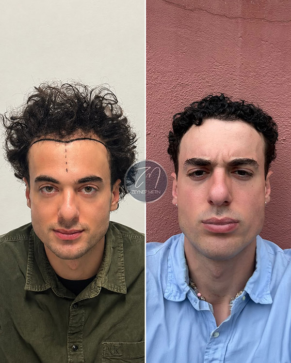 fue-method-before-after-3