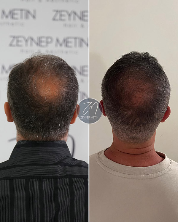 fue-method-before-after-4