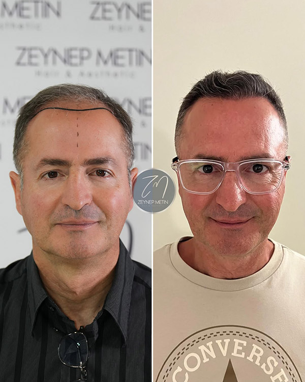 fue-method-before-after-5