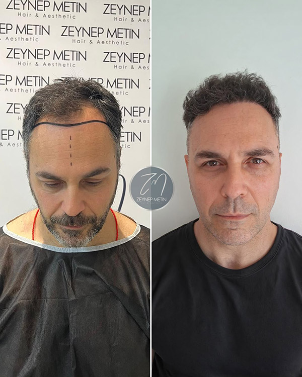 fue-method-before-after-6