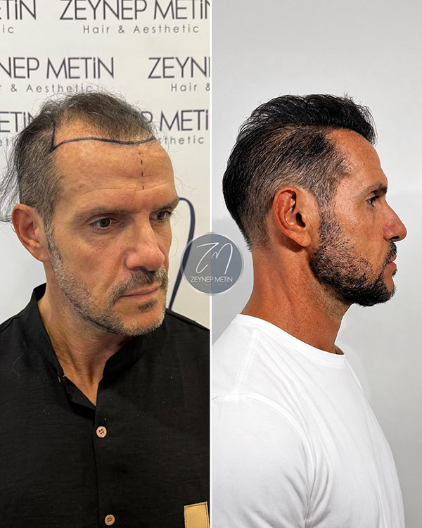 fue-method-before-after-7