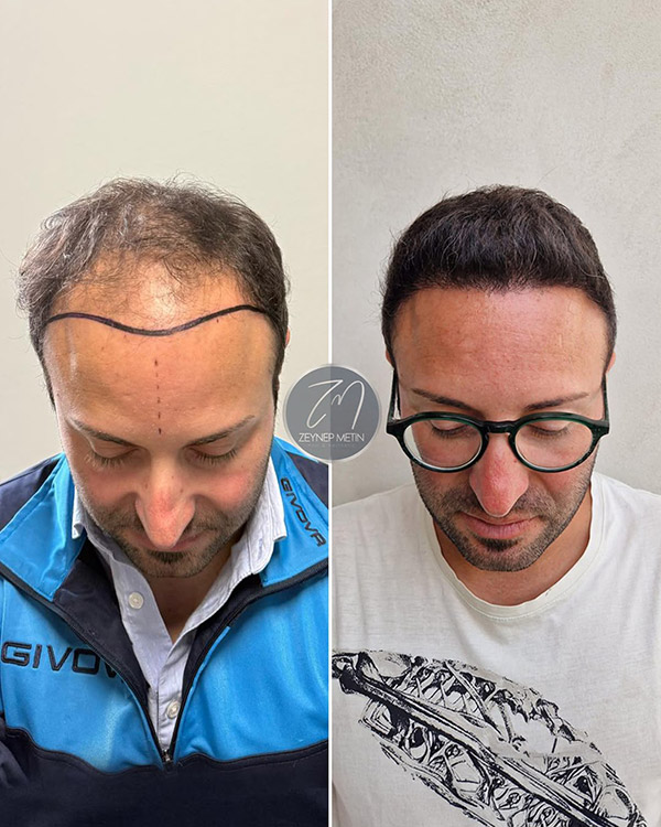 fue-method-before-after-8