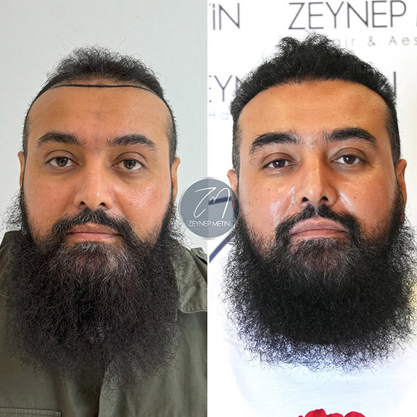sapphire-hair-transplant-bef-1