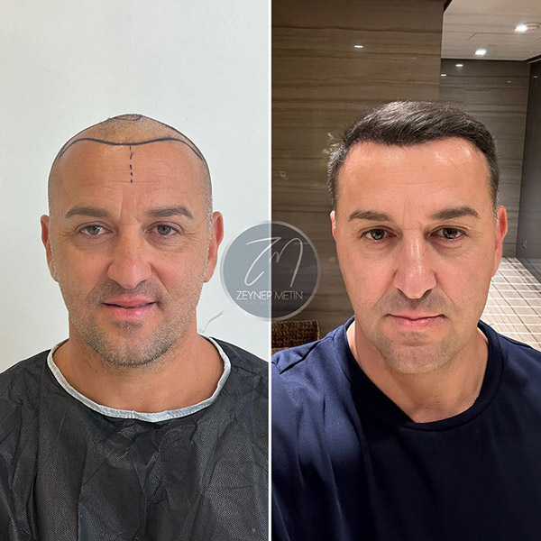 sapphire-hair-transplant-bef-4