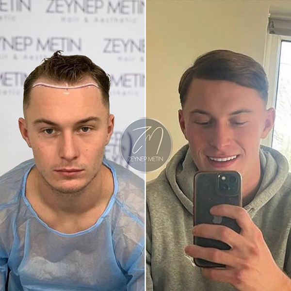 sapphire-hair-transplant-bef-6